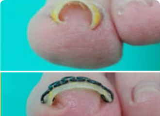 矯正後のビフォーアフター