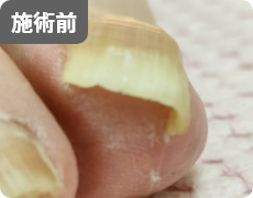 施術前