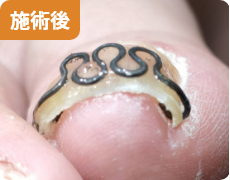 施術後